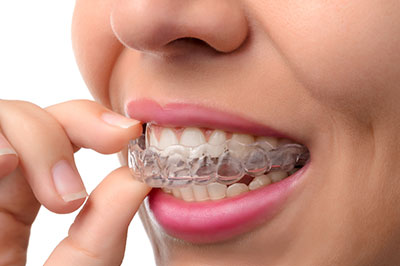 invisalign