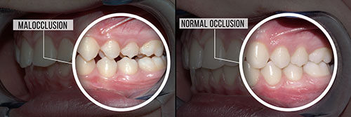 malocclusion