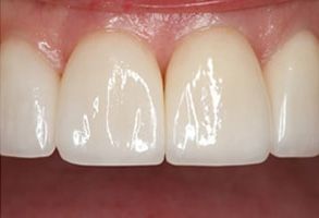 Zwahlen and Marshall Family Dentistry | Veneers, Air Abrasion and Implant Dentistry
